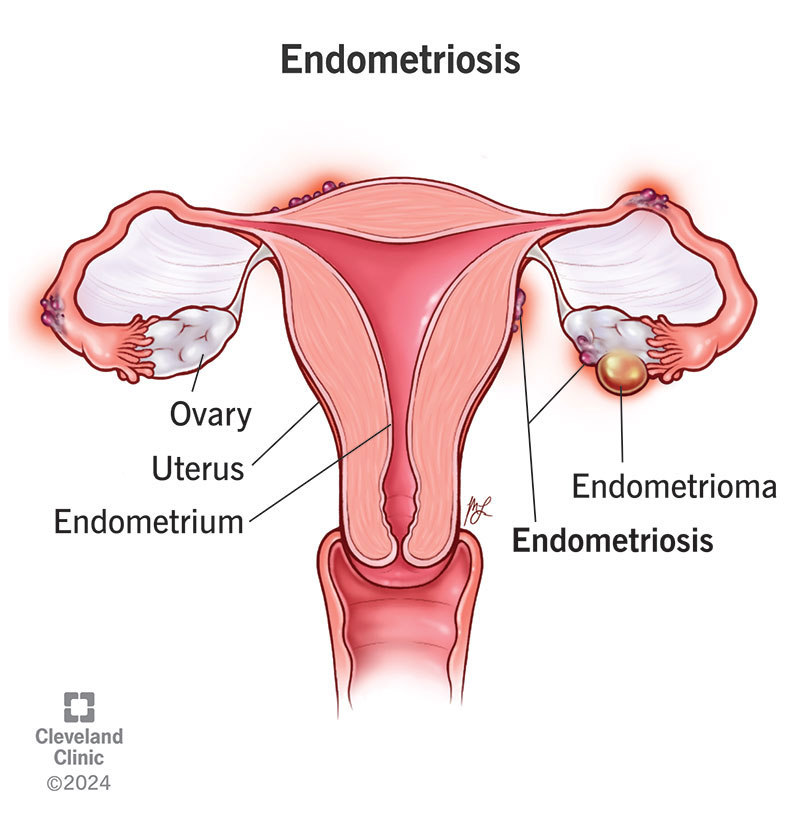 Endometriosis Symptoms: When Period Pain Is More Than ‘Just a Bad Period’ 1 Endometriosis Symptoms